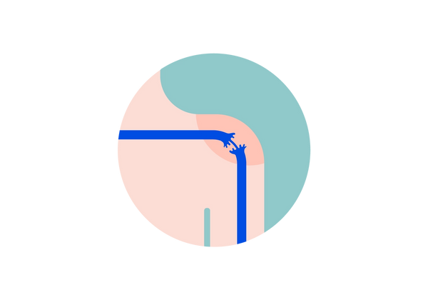 Shoulder with a blue frayed nerve within a green circle.