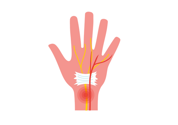 Uma ilustração de uma mão. Visíveis são os ligamentos e nervos afetados pela síndrome do túnel do carpo. Círculos concêntricos vermelhos emanam do pulso. Sobre o nervo amarelo há uma mancha branca.