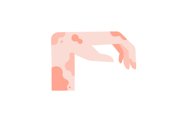 Eine Illustration einer Hand und eines Handgelenks, die im rechten Winkel gebogen sind. Der größte Teil der Haut ist hell pfirsichfarben und mit dunkleren pfirsichfarbenen Flecken bedeckt.