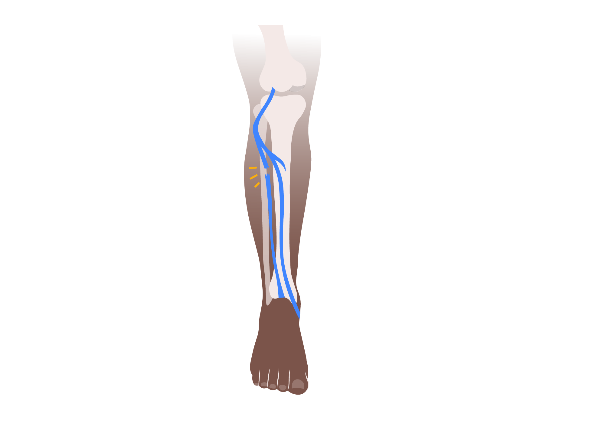 Engourdissement dans les jambes inférieures | 10 causes possibles ...