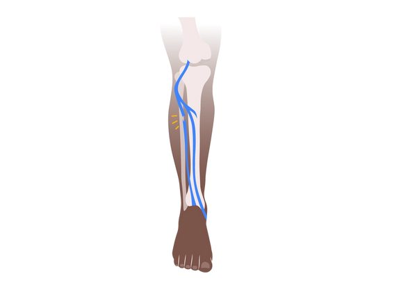 Ilustração de uma perna com pele morena. Através da pele, os ossos são visíveis, assim como a divisão do nervo fibular azul. Três linhas amarelas saem do nervo dividido.
