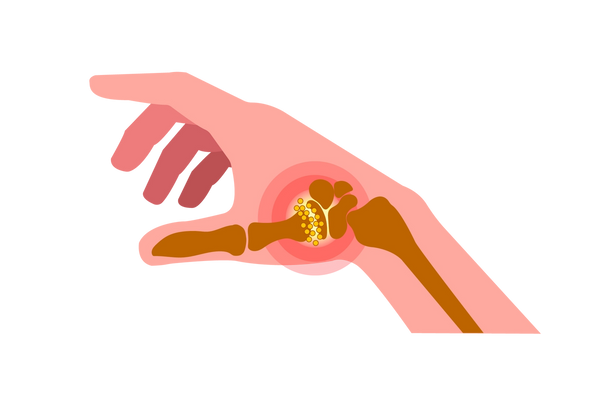 An illustration of a side angle of a right hand facing down and fingers pointing left. Medium brown bones are visible in the arm, wrist, and thumb, and small yellow circles are clustered at the base of the thumb. The skin is light peach-toned, but is light yellow in the joint area to emphasize the joint, as well as red concentric circles. The rest of the fingers are slightly outstretched but curled down.