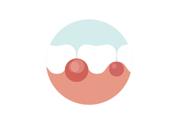 Nahaufnahme des Zahnfleisches mit Schwellung in der Nähe der Zähne.