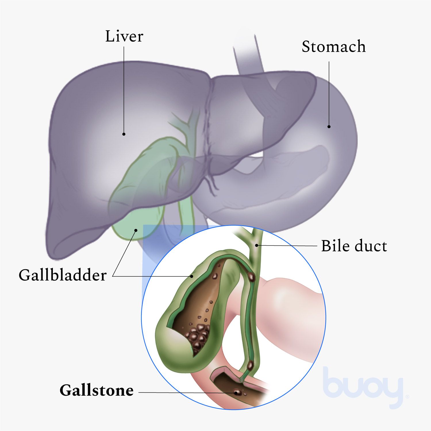 What Are Gallstones When Do You Treat Them Buoy