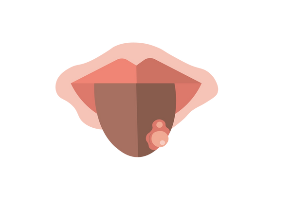Eine Illustration einer braunen Zunge, die aus rosa Lippen herausragt. Unten rechts auf der Zunge befindet sich ein Bereich mit zwei rosafarbenen Wunden.