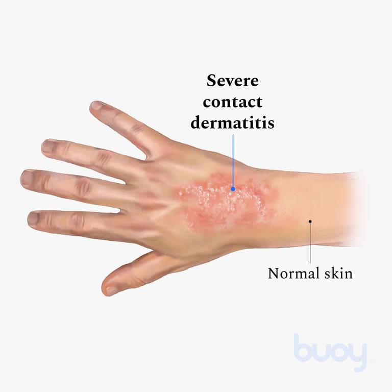 contact dermatitis arc égési sérülések és vörös és foltok