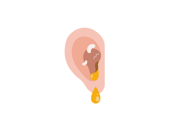 Un oído con una infección visible. Se puede ver una gota de pus saliendo del oído.