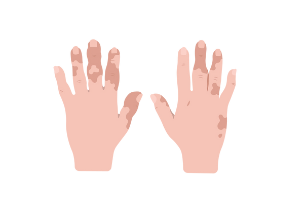 Uma ilustração da parte superior de um par de mãos com os dedos estendidos. Existem manchas de pêssego avermelhado na pele clara em tom de pêssego.