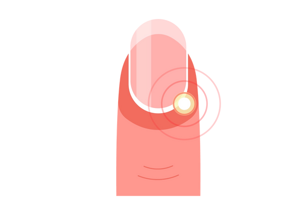 Eine Abbildung einer Fingerspitze mit Rötung um die Nagelbasis. Die weiße Nagelhaut ist zu sehen. Am Rand der Nagelhaut unten rechts im Nagelbett befindet sich ein gelber Fleck. Aus dem gelben Fleck gehen zwei rote konzentrische Kreise hervor, die die Infektion hervorheben. Der Rest des Fingers ist hell-mittel-rosig-pfirsichfarben.