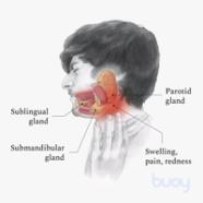 Parotid Duct Obstruction