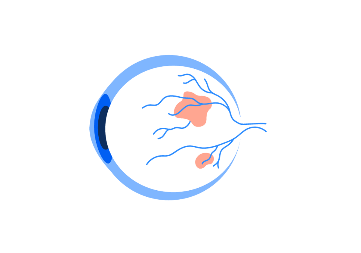 Tratamento da Retina - Instituto de Moléstias Oculares