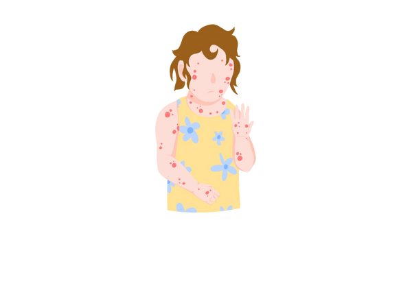 An illustration of a frowning little girl scratching herself with one hand and looking at the other hand. She is covered in clusters of red spots. She has short brown messy hair and is wearing a yellow dress with light blue flowers. Her skin is light peach and the chickenpox is bright red.