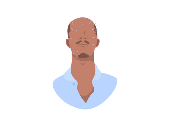 Illustration d’un homme avec la tête penchée en arrière. Des lignes courtes s'étendent de son visage pour montrer des picotements.