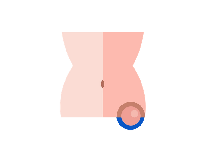 Is A Lump In Lower Right Abdomen Serious What You Need To Know
