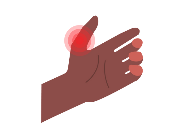 Eine Abbildung der Innenseite einer Hand mit entspannten und leicht gebeugten Fingern und nach oben gestrecktem Daumen. Rote konzentrische Kreise, die Schmerzen anzeigen, kommen von der Daumenbasis. Der Rest der Hand ist dunkelmokkafarben.