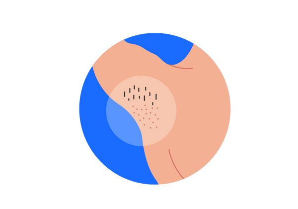 An illustration inside a medium blue circle of an armpit and shoulder with the arm raised. A semi-transparent white circle covers the whole armpit. At the top of the armpit, there is a cluster of brown hairs, and below that are pink dots where there is no hair. The rest of their skin is light peach-toned.