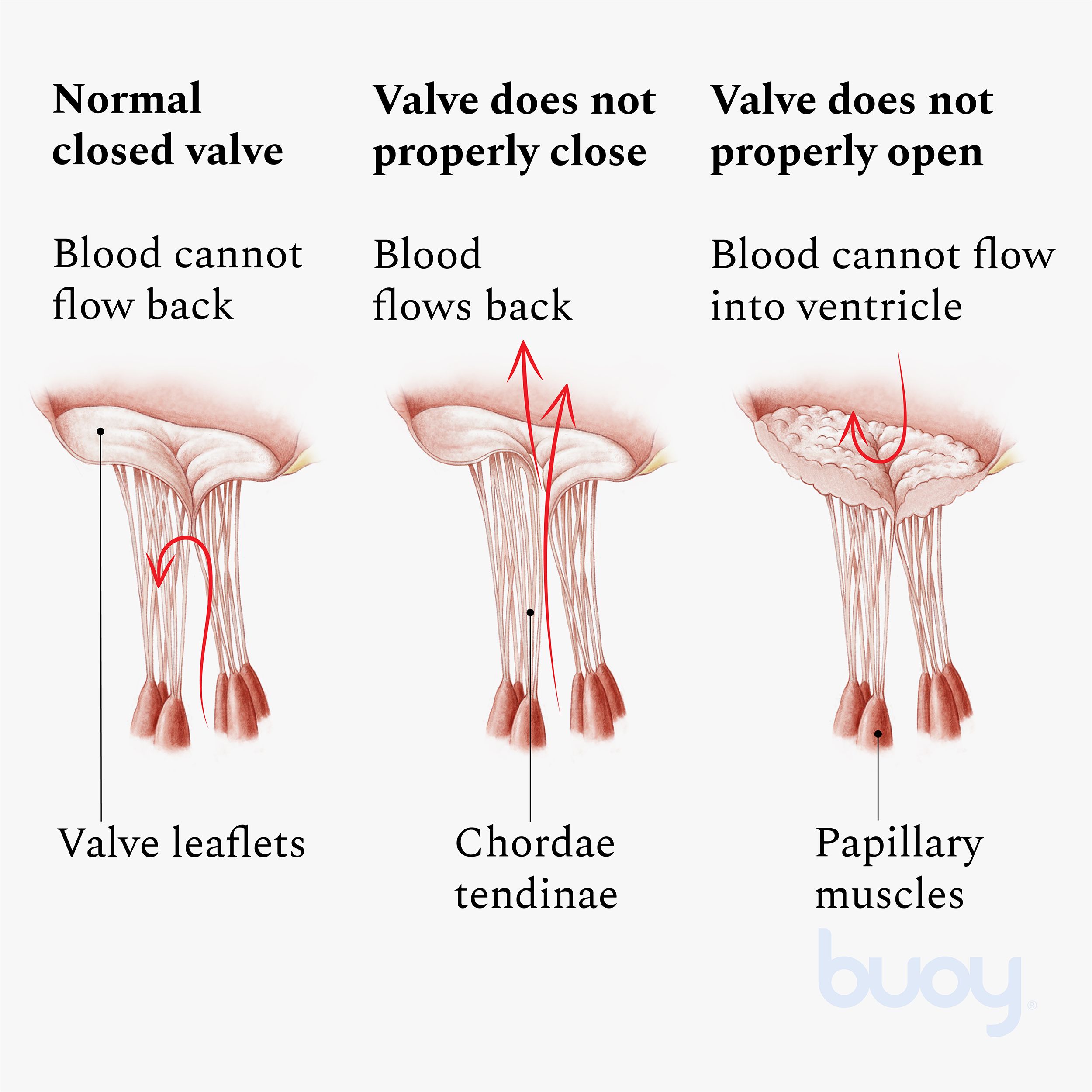 Valvular Heart Disease Heart Disease Symptoms and Causes Buoy