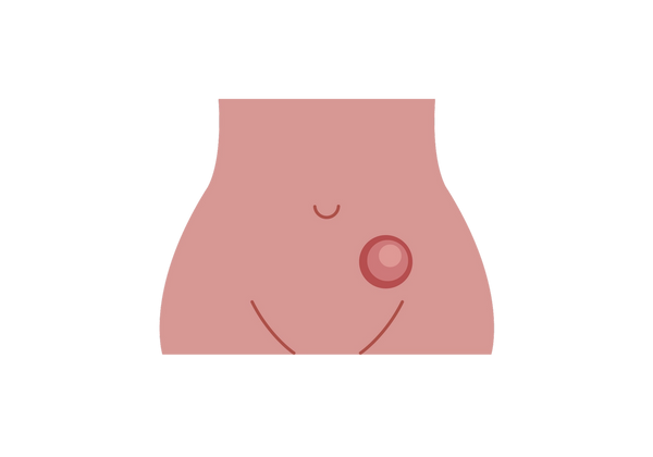 A barriga e os quadris de uma mulher de frente. Há um grande círculo vermelho com um círculo menor rosa mais claro no canto inferior direito do umbigo.