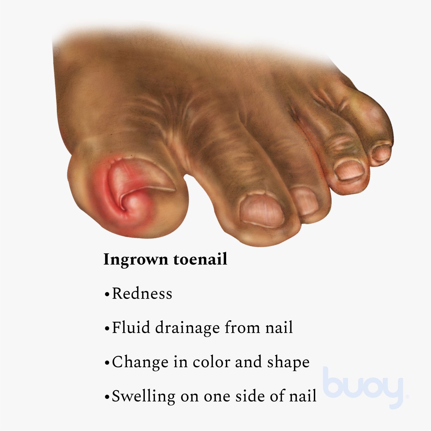 Watch Out for Ingrown Toenails
