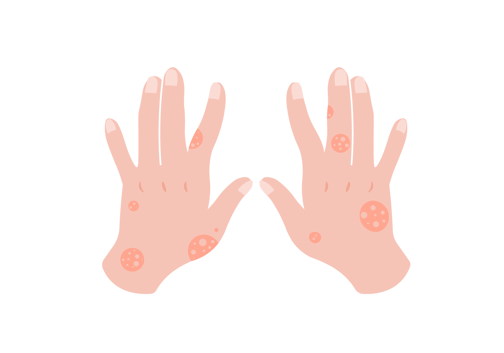 O que acontece com a dermatite de contato?, image size:2001x1401