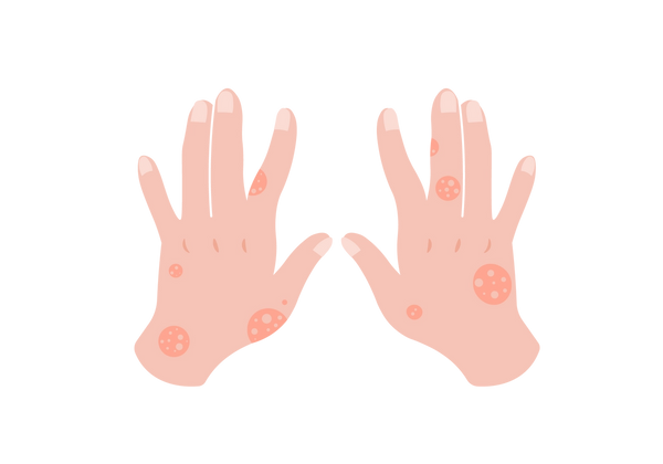 Una ilustración de un par de manos de color melocotón claro, que muestra el dorso de ellas. Los dedos se estiran en su mayoría rectos y hay círculos de tonos melocotón más oscuros que manchan las manos. Dentro de los círculos hay círculos más pequeños que combinan con el resto del tono de la piel.