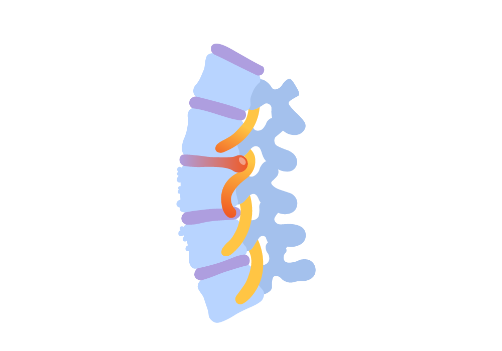 Spinal Stenosis | Reasons Spinal Stenosis Happens & Treatment