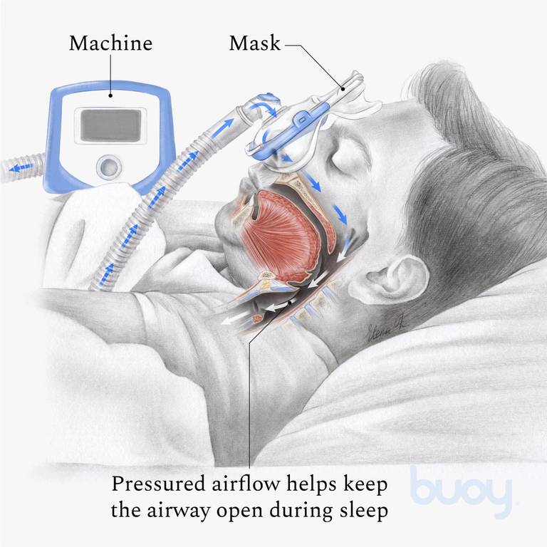 Terapia con CPAP para apnea del sueño, ¿aumenta niveles de