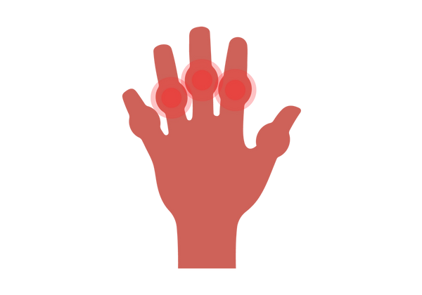 Uma ilustração de uma mão com os dedos estendidos. Cada junta do meio está inchada. Círculos concêntricos vermelhos que irradiam das três juntas médias inchadas mostram inchaço. O resto da mão tem um tom de pêssego médio-escuro.