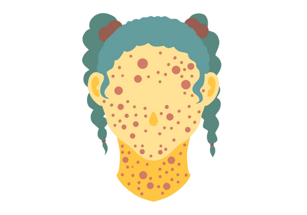 An illustration of a young girl from the neck up with a measles rash. She has yellow skin and a small teardrop-shaped nose. Her skin is covered in red spots of varying sizes. Her hair is medium green and tied up in two braided pigtails with brown bobble hair ties.