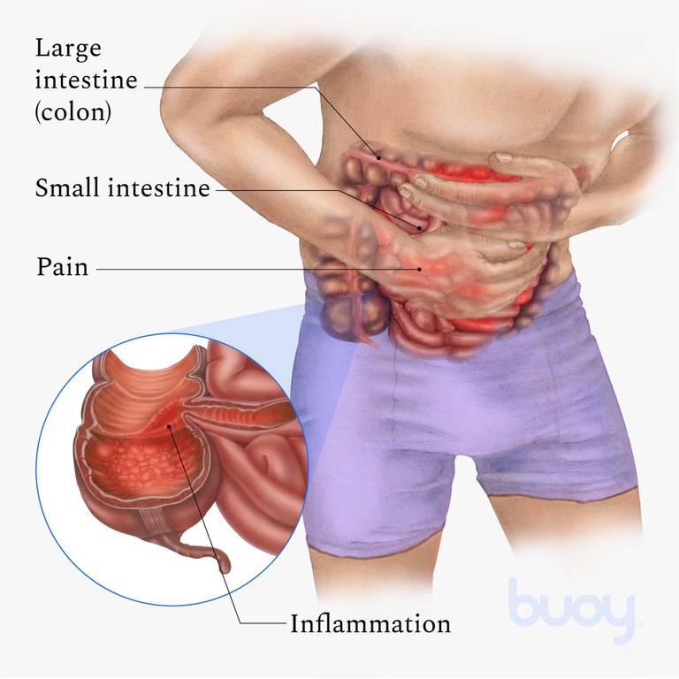 Crohn's Disease  Common Symptoms & Getting Treatment