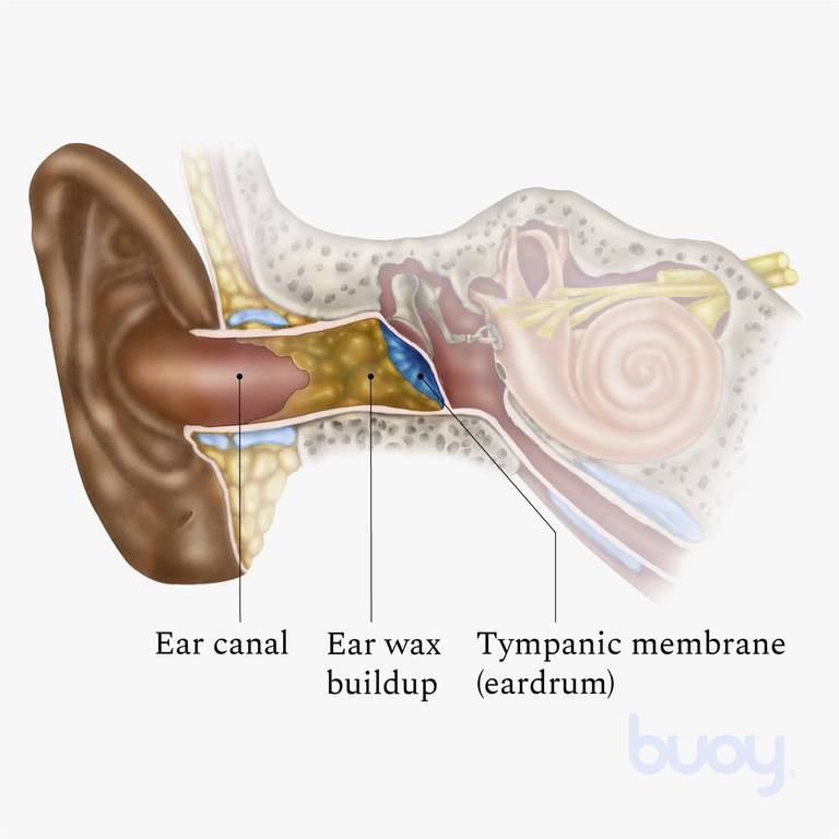 Smeren Secretaris afstuderen Earwax Blockage | How to Remove Earwax | Buoy Health