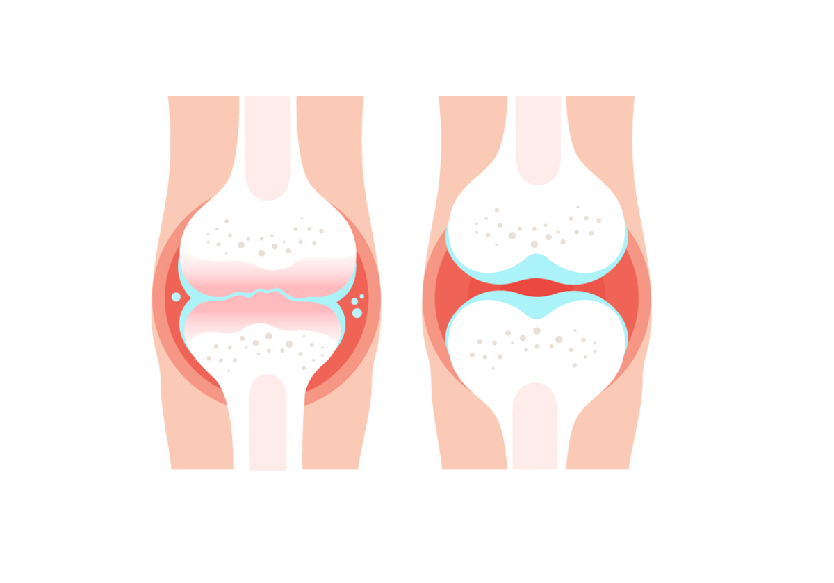 rheumatoid arthritis és osteoarthritis hogyan kell kezelni a lábujjak ízületeiben fellépő növekedéseket