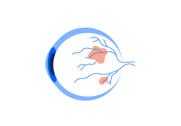 Una ilustración de una vista lateral de un globo ocular. El globo ocular es blanco con venas azules medianas que lo atraviesan desde la parte posterior. Un contorno azul claro rodea la parte frontal del globo ocular, y desde un lado se ven un iris azul medio y una pupila azul oscuro. Dos manchas rojas son visibles en el blanco del globo ocular.