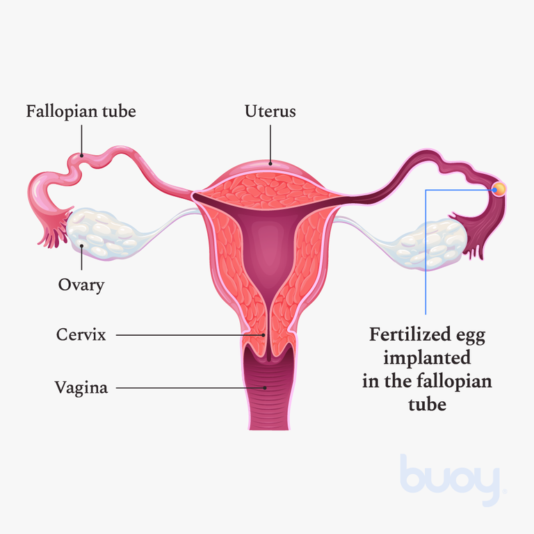 Ectopic Pregnancy Signs Symptoms Causes Treatments