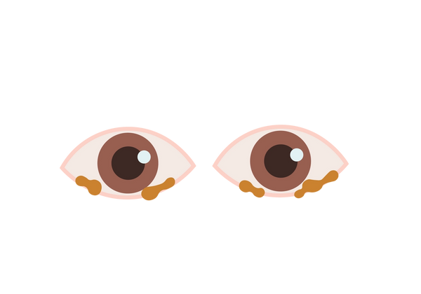 An illustration of two pink eyes. The irises are medium brown and the pupils are dark brown. Yellow-brown clumps of discharge are on the bottom eyelid.