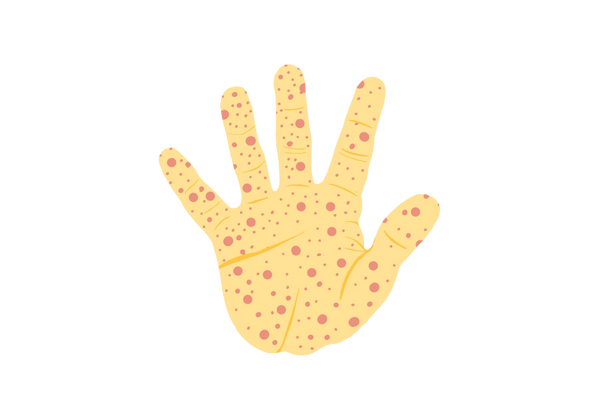 Une illustration de la paume d’un enfant. La peau est jaune et les doigts sont tendus. La paume et les doigts sont couverts d'une éruption rouge distinctive composée de points rouges de différentes tailles, un symptôme courant du virus Coxsackie.