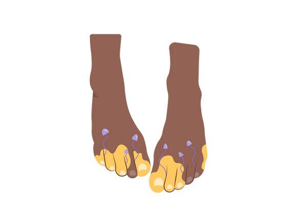 Una ilustración de dos pies en tonos melocotón de color marrón oscuro desde una vista parcialmente de arriba hacia abajo. Hay manchas amarillas en la mayoría de los dedos de los pies y pequeños hongos morados que crecen hacia arriba entre los dedos.