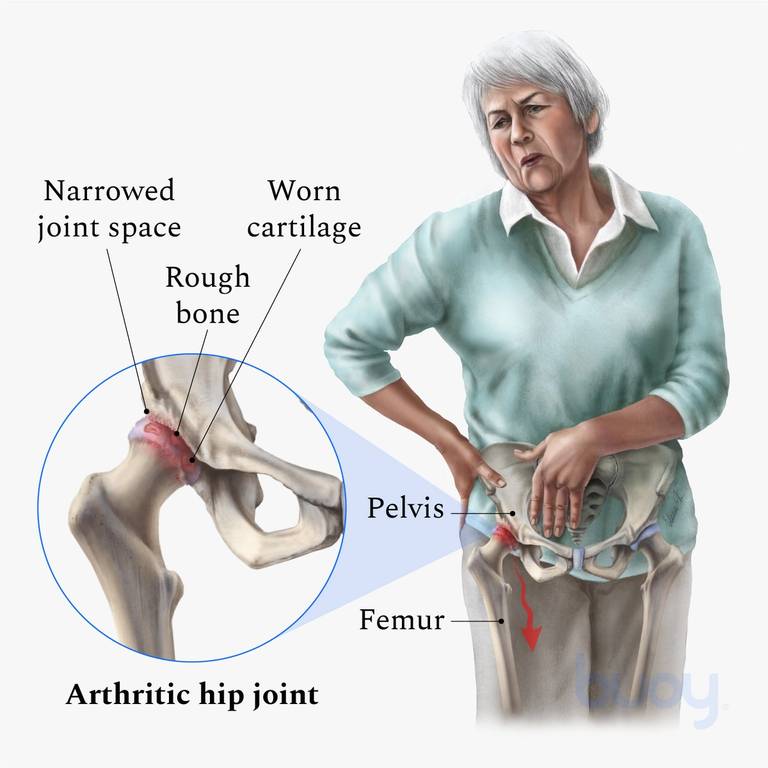 Why Does My Hip Hurt?, Top 3 Causes of Hip Pain