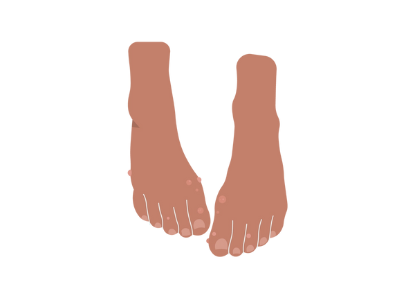 Uma ilustração de um par de pés voltados para a frente, a partir de uma visão aérea. Os pés são em tom de pêssego médio-escuro e têm saliências em tons de pêssego mais claros concentradas ao redor dos dedos, mas se espalhando para o resto de cada pé também.