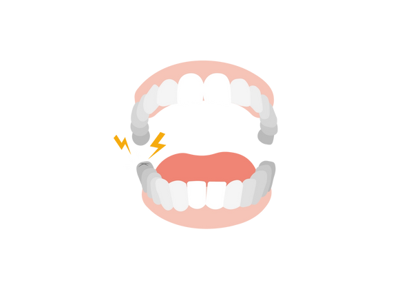 Eine Illustration eines offenen Kiefers mit Zähnen, Zahnfleisch und Zunge. Der Zahn, der sich am nächsten links hinten im Unterkiefer befindet, hat eine kleine „X“-Form und zwei gelbe Blitze sowie drei kleine weiße Linien gehen von dem Zahn aus. Die Zähne sind weiß und werden umso dunkler, je tiefer sie im Kiefer liegen. Das Zahnfleisch ist hellrosa und die Zunge ist dunkler rosa.