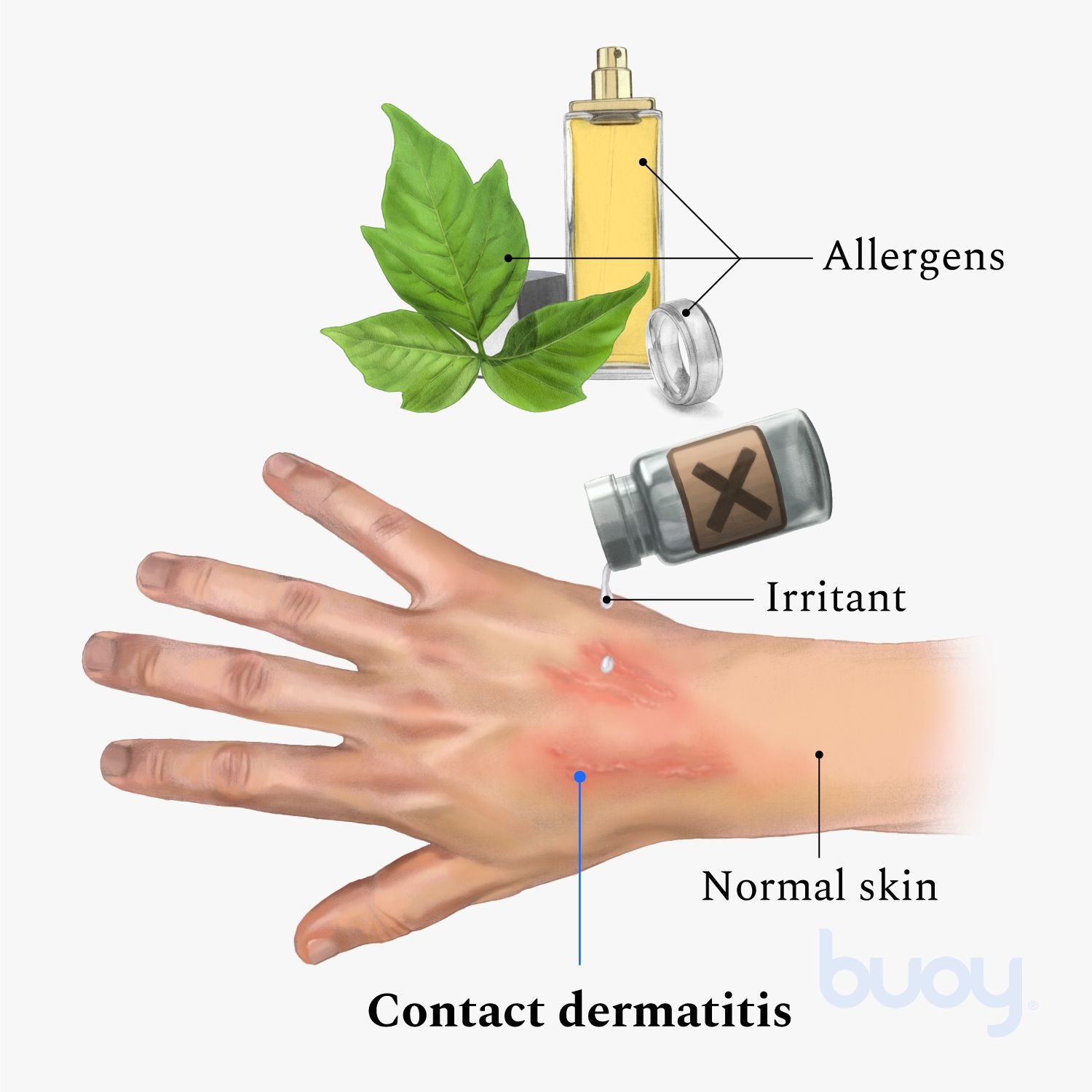 Irritant VS. Allergic Contact Dermatitis: What's the Difference