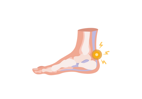 An illustration of a cross section of a foot from the side, with the toes pointing left. The skin is light peach-toned, and the bones and tendons are shades of off-white, light pink, and light blue. A yellow spot is on the achilles tendon, right above the heel, and two yellow concentric circles come from the spot, as well as three yellow lightning bolts.