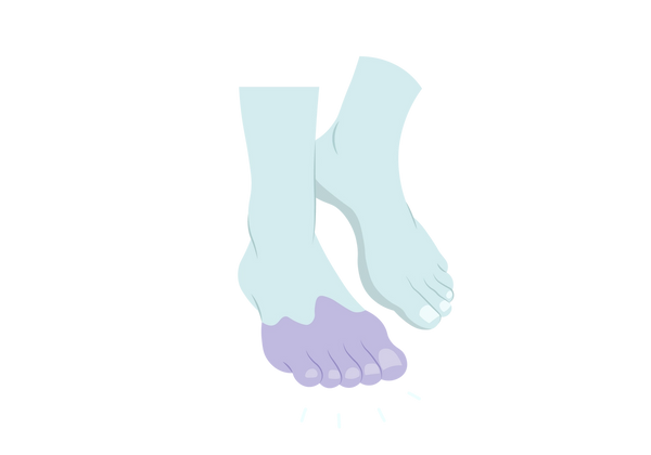Uma ilustração de dois pés verdes claros, no meio do passo. Há uma mancha roxa clara nos dedos dos pés e na planta do pé em primeiro plano. Quatro linhas verdes claras vêm da área roxa.