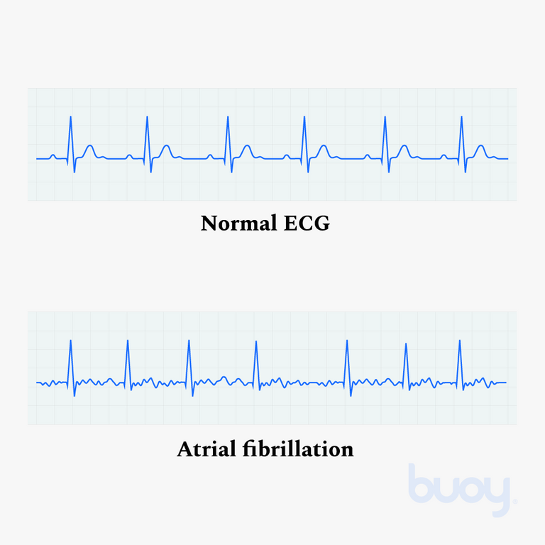 atrial fibrillation)