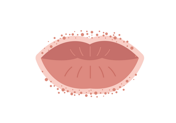Rash around the outside of the lips.