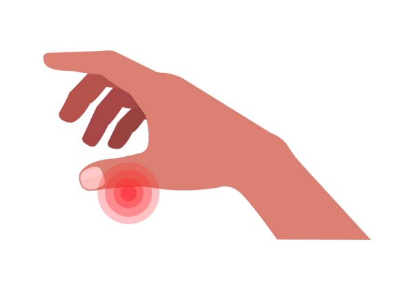 Uma ilustração de um ângulo lateral de uma mão direita voltada para baixo e dedos apontando para a esquerda. Círculos concêntricos vermelhos mostram dor perto da base da unha. A pele tem um tom de pêssego meio escuro e a unha é de um rosa mais claro. O resto dos dedos ficam relaxados naturalmente.