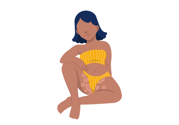Una ilustración de una mujer en traje de baño sentada con la pierna izquierda doblada frente a ella en el suelo y la pierna derecha doblada hacia arriba. Hay formas de manchas rosadas redondas con bordes de color rosa más claro alrededor de la entrepierna y la parte interna de los muslos. El resto de su piel es de un tono chocolate cálido medio-oscuro, su cabello es una melena corta de color azul oscuro y lleva un traje de baño de rayas amarillas y blancas.