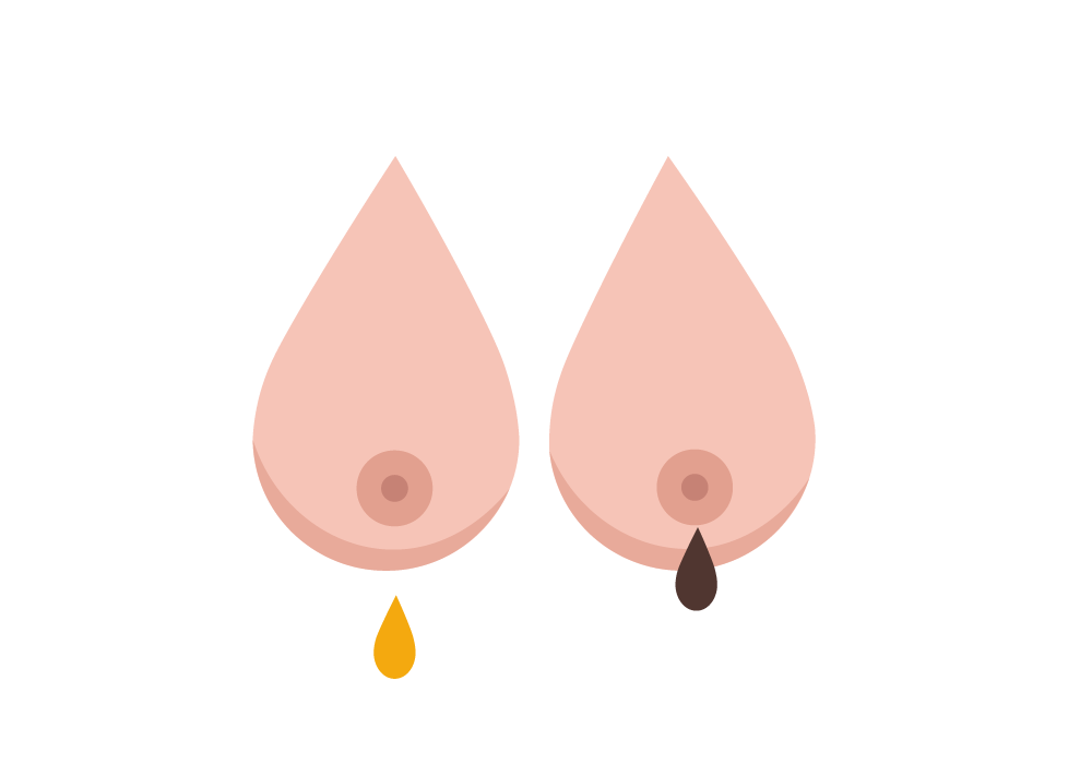 This is my nipple. My boobs have been really sore today i gently squeezed my  nipples and they both had plenty of this fluid. Is that normal? I mean I  have 3