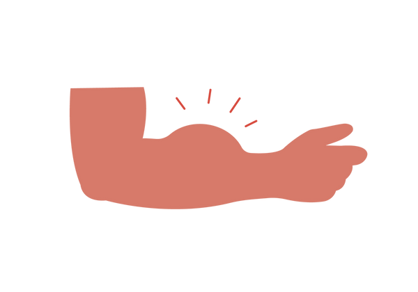 An arm bent at the elbow with a large bump on the forearm. Four red lines emanate from the bump.