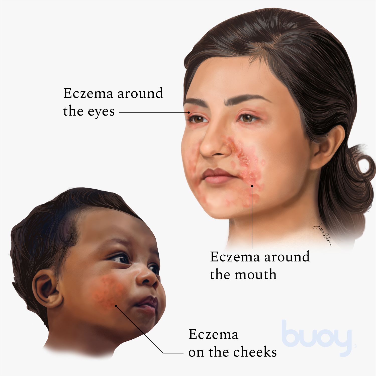 eczema face